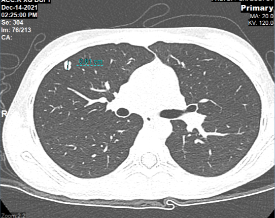 CT scan of K.T 's lung showed metastatic lung tumor after 1 year of the knee tumor removal surgery
